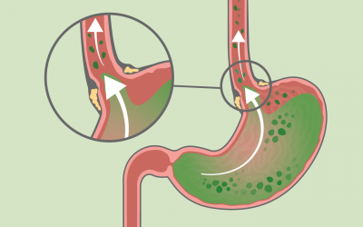 La réflexologie en pédiatrie – le reflux