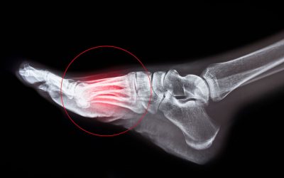 La réflexologie du sport – la fracture de fatigue
